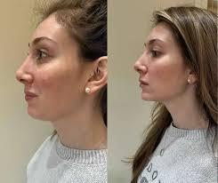 Jawline Filler Before and After: Photos ...